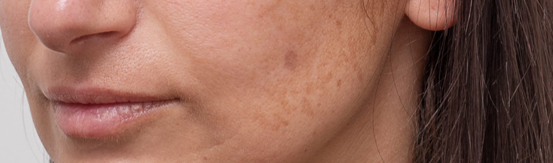 Melasma Condition